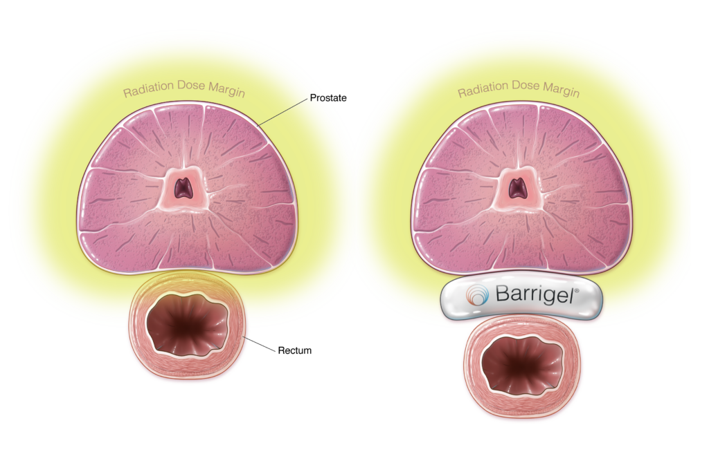 Barrigel for rectal spacing